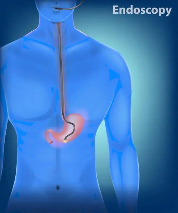 Illustration of a medical endoscopy procedure showing a tube inserted through the mouth, down the esophagus, and into the stomach of a human body, with the word Endoscopy in the top right corner.